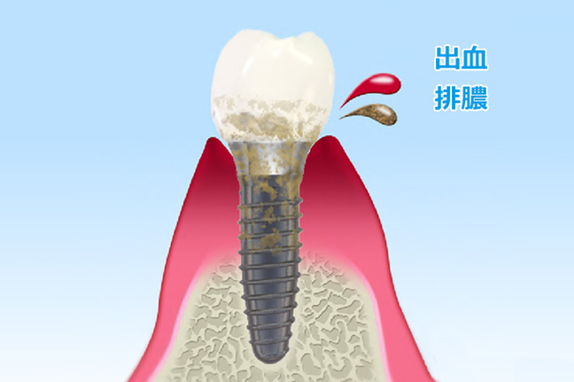 インプラント周囲炎